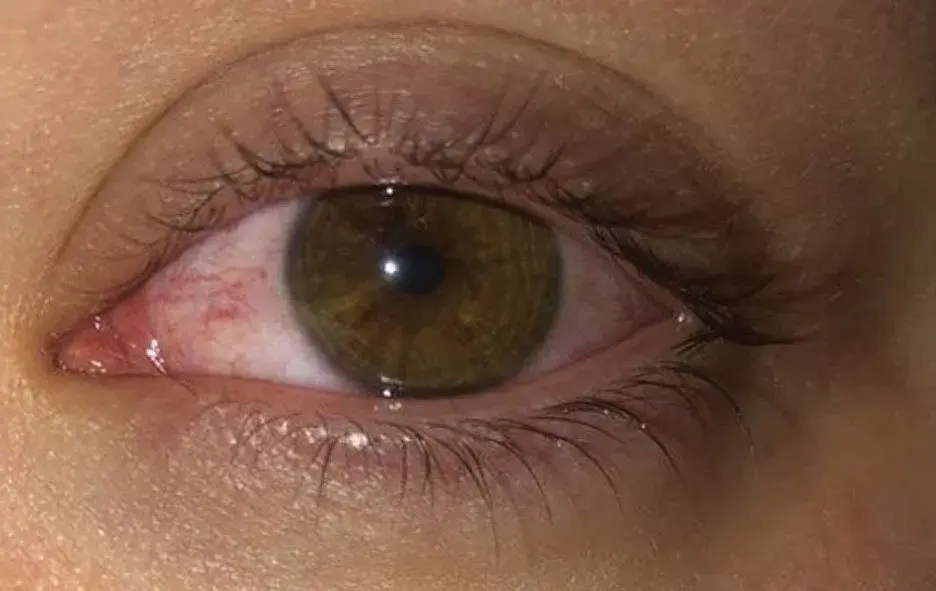 Close-up of an eye showing redness and irritation after contact lens wear.