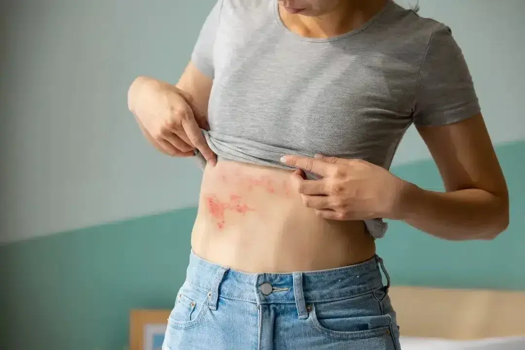 A woman showing a rash on her abdomen, indicative of shingles.