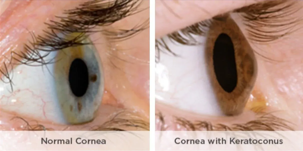 Side-by-side close-ups of two eyes: the left shows a normal round cornea, while the right depicts keratoconus with a cone-shaped bulge. Labels identify each condition, highlighting what a Brisbane keratoconus expert might see before cross-linking treatment.